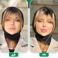 تخفیف جشنواره ژل بوتاکس ۷۵۰ تا ۱۷۰۰