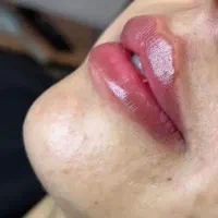 تزریق ژل لب،بوتاکس،مزو تراپی،هایفو تراپی،لیزر|خدمات آرایشگری و زیبایی|فردیس, شهرک ارم|دیوار