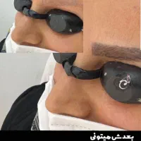 رفع تیرگی بدن حذف تتو صورت و بدن. کربن تراپی|خدمات آرایشگری و زیبایی|تربت‌حیدریه, کاشانی|دیوار