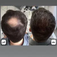 ریزش موهاتو درمان کن