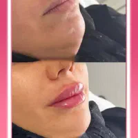 فیلر ایتالیایی Nuxiwell آفر ویژه به علت افتتاحیه|خدمات آرایشگری و زیبایی|تهران, سید خندان (جلفا)|دیوار