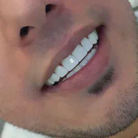 کامپوزیت دندان جشنواره/ترمیم|خدمات آرایشگری و زیبایی|تهران, مرزداران|دیوار