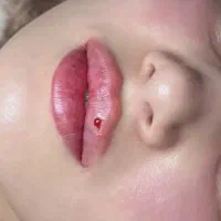 جشنواره  بزرگ فیلر و بوتاکس تزریق کل صورت فقط۲/۷۵۰