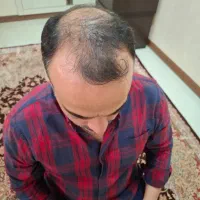 کاشت مو پرتراکم،اقساطی،تضمینی