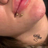 خدمات زیبایی  ساکشن و تزریق فیلر های بادی