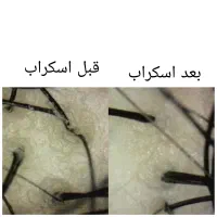 خدمات کراتین -اسکراب کف سر