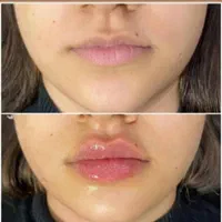 اف ویژه ژل بوتاکس بندرعباس|خدمات آرایشگری و زیبایی|بندرعباس, |دیوار