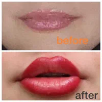 تزریق ژل و بوتاکس، لیزر موهای زائد، لاغری تضمینی