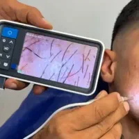 مشاوره داوطلبانه ریزش مو