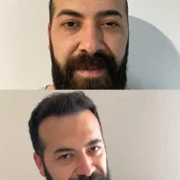 کاشت مو تبریزقیمت مناسب اقساطی فول تراکم|خدمات آرایشگری و زیبایی|صوفیان, |دیوار