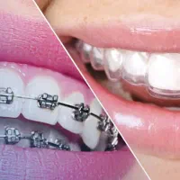 ارتودنسی بدون پیش پرداخت و بدون رفت و آمد