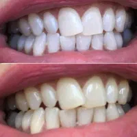 بیلیچینگ(سفیدشدن دندان طبیعی)فقط ۵میلیون