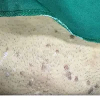 درمان بیماری زگیل در 6 روز