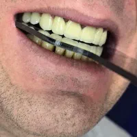 ساخت انواع دست دندان .روکش .لمینت باکیفیت بالا|آرایشی، بهداشتی، درمانی|تهران, مجیدیه|دیوار
