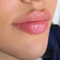 حجم دهی لب (بدون دردوتزریق)