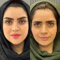 تزریق فیلر، بوتاکس،  مادلینگ زیر نظر متخصص|خدمات آرایشگری و زیبایی|کرمانشاه, |دیوار