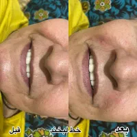جشنواره آفر ویژه ژل سیسی 770 و بوتاکس 900|خدمات زیبایی و سلامت|شیراز, رازی|دیوار
