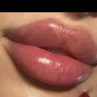 ژل و بوتاکس و مزو ژل