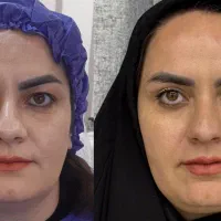 بلفاروپلاستی فقط ۱۱ تومن