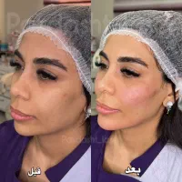 تزریق فیلر خط لبخند،چانه،گونه و زاویه فک توسط پزشک