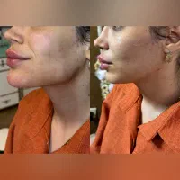تزریق تخصصی ژل و بوتاکس  مشاوره رایگان|خدمات آرایشگری و زیبایی|اصفهان, خلیل آباد|دیوار