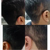 اسکالپ تخصصی در کلینیک پوست مو کاشت میکرو اسکالپ|خدمات آرایشگری و زیبایی|مشهد, شهید فرامرز عباسی|دیوار