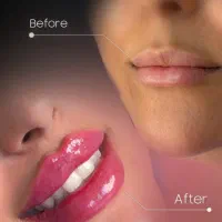 بوتاکس پیشانی،خط اخم رایگان شد توسط پزشک|خدمات آرایشگری و زیبایی|کاشان, بهشتی|دیوار