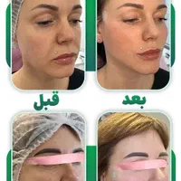 نیازمند مدل برای ترریق نخ لیفت یا جوان ساز