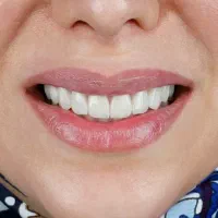 ایمپلنت و روکش اقساطی دندانپزشکی در خرم آباد|خدمات آرایشگری و زیبایی|اندیمشک, |دیوار