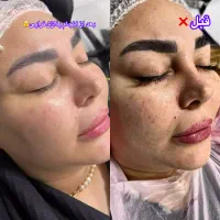 پلاژن تراپی /هایفو تراپی /لیزر بدن/کربوکسی|آرایشگاه و سالن‌های زیبایی|مشهد, کارگران|دیوار