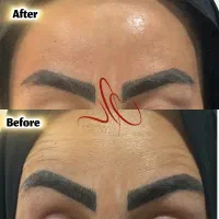 تمدید تخفیف ۳۰ درصدی بوتاکس ۱/۹۸۰/۰۰۰