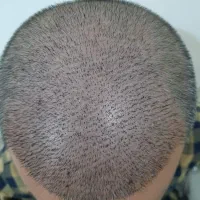 کاشت مو و ابرو ریمو تتو با دستگاه پیشرفته اهواز|خدمات آرایشگری و زیبایی|خرمشهر, |دیوار