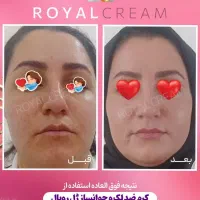 کرم ژل رویال بهترین ضدلک