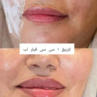 چهره‌ای که عاشقش میشی،بوتاکس،ژل وفیلر توسط متخصص|خدمات آرایشگری و زیبایی|ارومیه, |دیوار