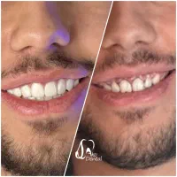 ایمپلنت و زیبایی دندان اقساط ۱۲ ماهه اکو دنتال|خدمات آرایشگری و زیبایی|تهران, خانی آباد نو شمالی|دیوار