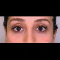 راهنمایی فیلر زیر چشم