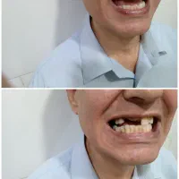 دندانسازی مصنوعی حرفه ای برای همه لبخندها|خدمات آرایشگری و زیبایی|مشهد, کوی سیدی|دیوار