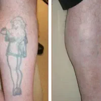 پاک کردن تتو.لیزرکیوسوییچ.PRP.کربن تراپی.روشن سازی|خدمات آرایشگری و زیبایی|اصفهان, سعادتآباد|دیوار