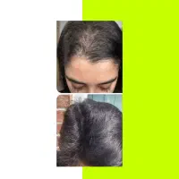 فرق نداره مشکلت ریش باشه مو باشه ابرو مژه