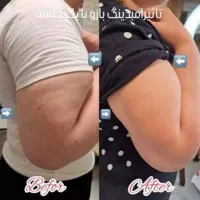 لاغری و لیفت با روش جدید امبدینگ|پزشکی|تهران, نیلوفر|دیوار