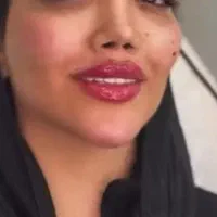 نیازمند مدل تزریق ژل|خدمات آرایشگری و زیبایی|ارومیه, |دیوار