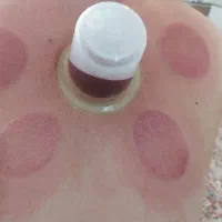 انجام انواع حجامت زالو درمانی بادکش درمانی