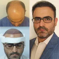 کاشت مو.ابرو.ریش درکیلنیک تخصصی|خدمات آرایشگری و زیبایی|قم, باجک دو|دیوار