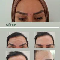 تزریق بوتاکس با متد حرفه‌ای و متریال با کیفیت