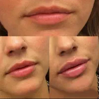 بوتاکس وتزریق ژل لیفت نخ بلفاروساکشن وکاشت مو|خدمات آرایشگری و زیبایی|مشهد, آزادشهر|دیوار