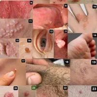 زگیل و تبخال و کامل از بین ببر|آرایشی، بهداشتی، درمانی|شاندیز, |دیوار