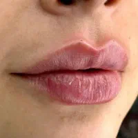 تزریق‌های زیبایی در منزل توسط پزشک