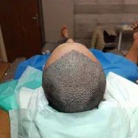 کاشت مو به روش Sp|خدمات آرایشگری و زیبایی|آذرشهر, |دیوار