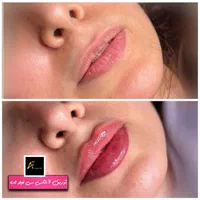 جشنواره  فیلر ژل بوتاکس prpمزوتراپی لیزر توسط پزشک