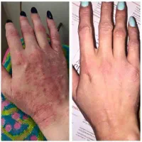 دیگه هیچوقت خارش و سوزش نداری